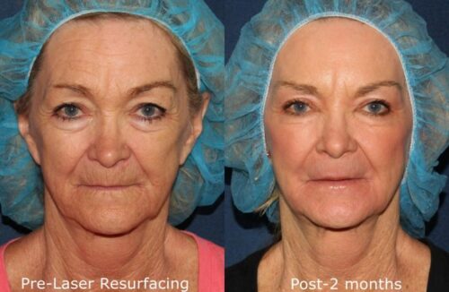 fractional laser resurfacing before and after results in San Diego