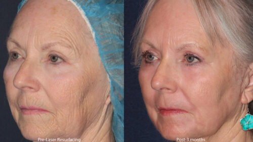 before and after results from a fractional laser resurfacing treatment in San Diego