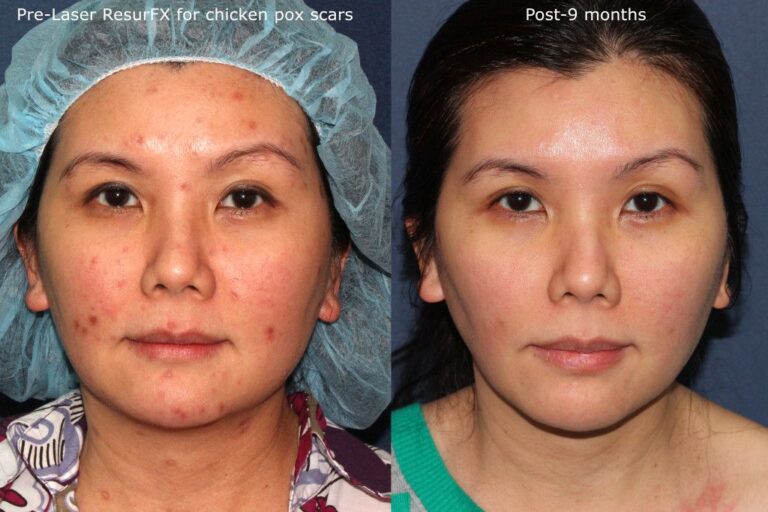 Laser Blemish Reduction San Diego