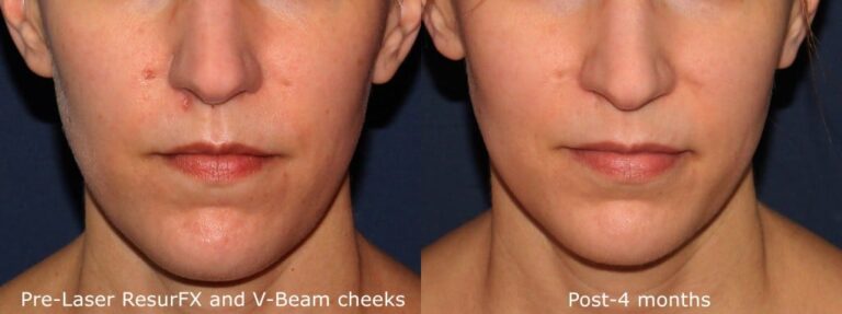 Before and after front image of ResurFX laser treatment on a female's face performed by Dr. Wu at our San Diego medical spa