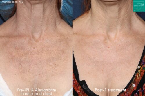 before and after results from an IPL laser treatment in San Diego, CA