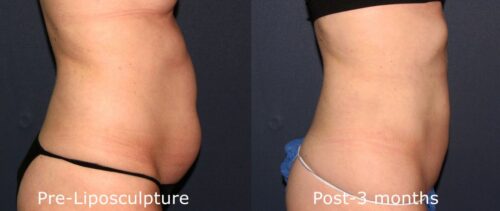 Tone That Body with LipoSculpture, San Diego Body Contouring