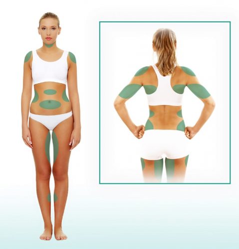 liposculpture body contouring diagram in san diego, ca