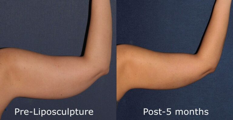 Before and after front image of liposculpture treatment on a female's arms performed by Dr. Goldman at our San Diego medi spa