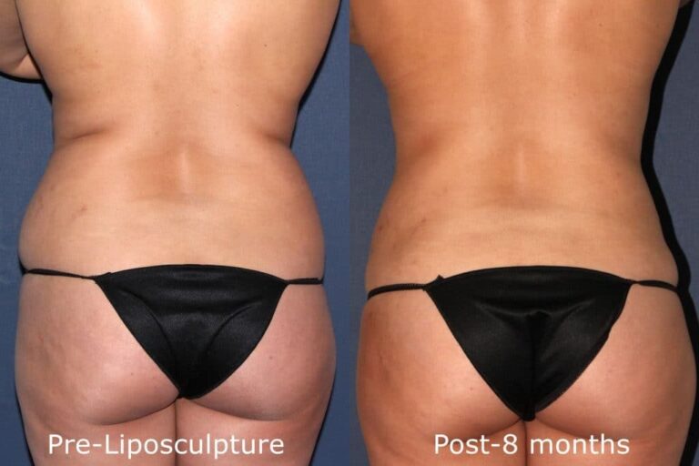 Before and after back image of liposculpture treatment on a female's hips and buttocks performed by Dr. Fabi at our San Diego medical clinic