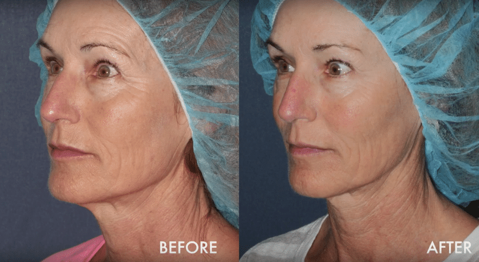 Actual un-retouched patient before and after liquid facelift treatment for facial rejuvenation. Disclaimer: Results may vary from patient to patient. Results are not guaranteed.