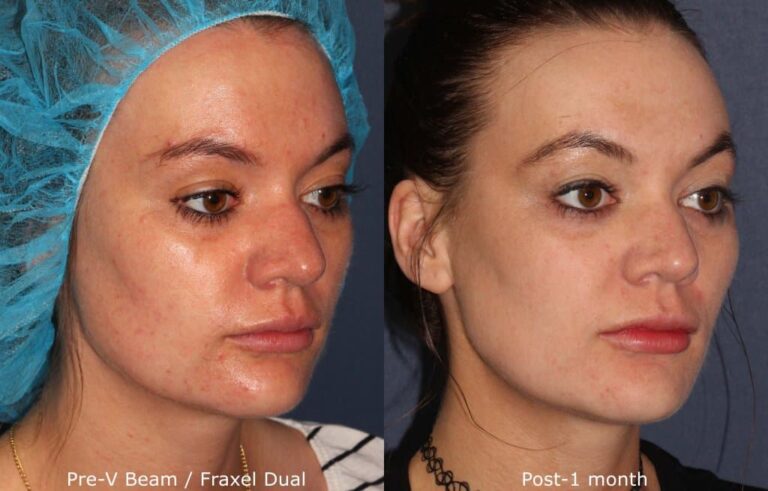 Before and after oblique image of Vbeam and Fraxel Dual treatment on a female's face performed by Dr. Fabi at our San Diego medi spa