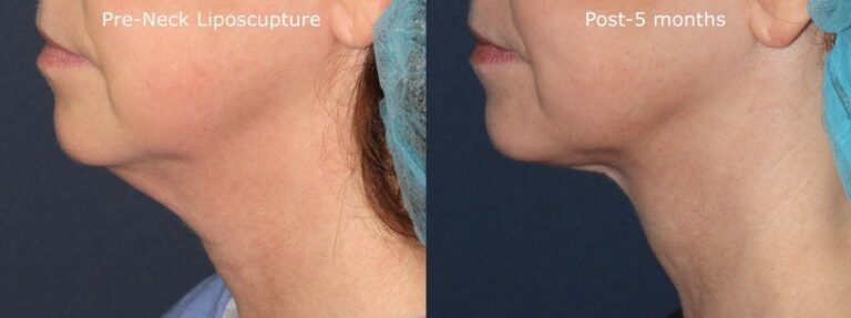 Before and after side image of liposculpture treatment on a female's chin and neck performed by Dr. Goldman at our San Diego medical spa