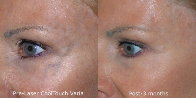 Before and after oblique image of CoolTouch Varia treatment on a female's veins around the eyes performed by Dr. Groff at our San Diego medical spa