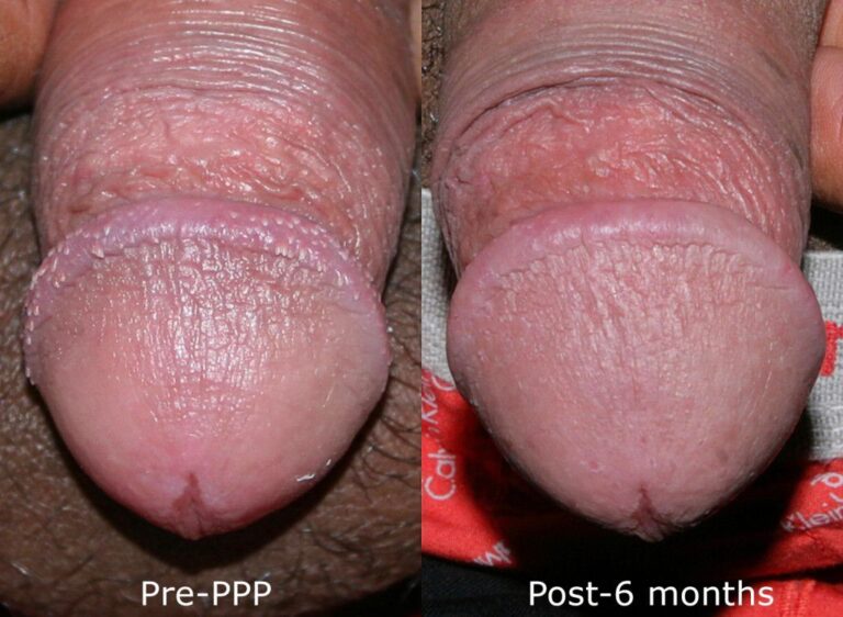 Before and after front image of CO2 laser treatment on a male's penis performed by Dr. Groff at our San Diego medical clinic