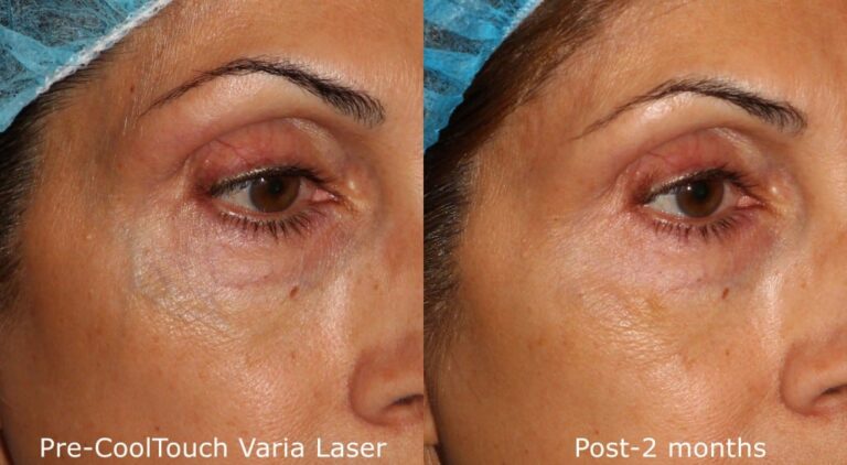 Before and after oblique image of CoolTouch Varia treatment on a female's veins around the eyes performed by Dr. Goldman at our San Diego medical spa