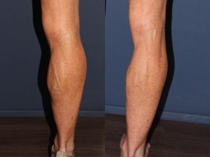 Phlebectomy Treatment Right Leg