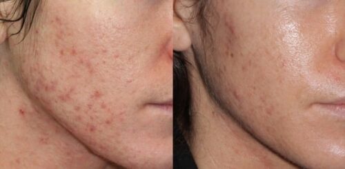 blue light pimple zits removal