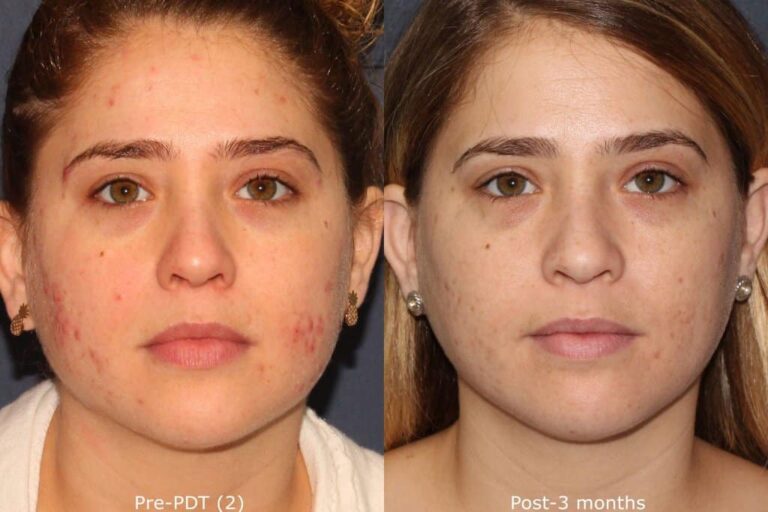 PDT for Acne by Dr. Wu San Diego