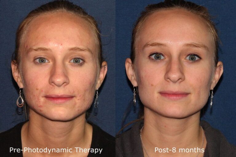 Before and after front image of photodynamic therapy on a female's face performed by Dr. Fabi at our San Diego medical spa
