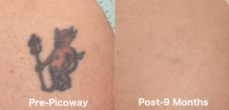 Before and after front image of Picoway laser tattoo removal on a female's shoulder performed by Dr. Groff at our San Diego medical spa