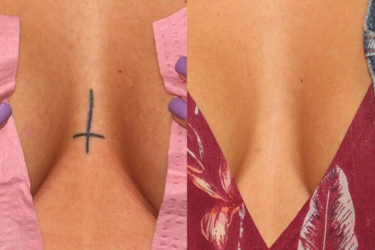 Before and after front image of PicoWay laser tattoo removal on a female's chest performed by Dr. Groff at our San Diego medical spa