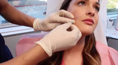 restylane facial injection in san diego, ca