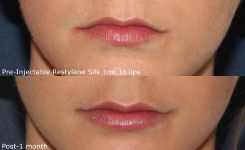 Before and after Restylane silk in San Diego