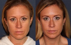 Restylane Tear Trough Filler Oceanside