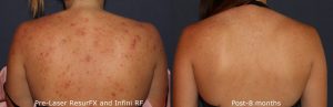 Laser Acne Scar Removal La Jolla