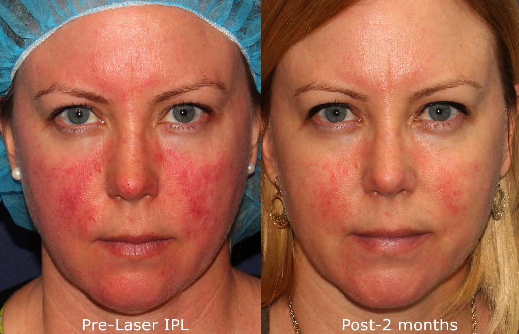 Laser Dermatology Treatment Med Spa San Diego, CA CLDerm photo