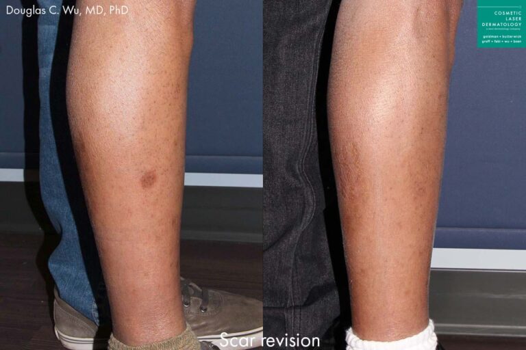 Laser treatment to remove scar from patient's leg by Dr. Wu. After procedure, scar is eliminated and leg is smoother and clearer.
