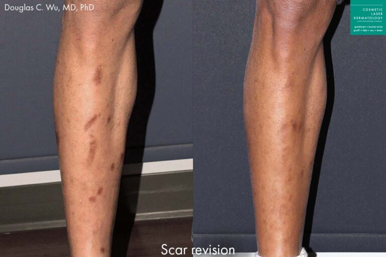 Laser treatment to remove scars from male patient's leg. After treatment, leg is noticeably clearer with fewer dark markings.