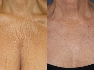 San diego IPL Sculptra Chest Rejuvenation