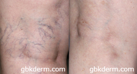 leg vein removal treatment in san diego, ca