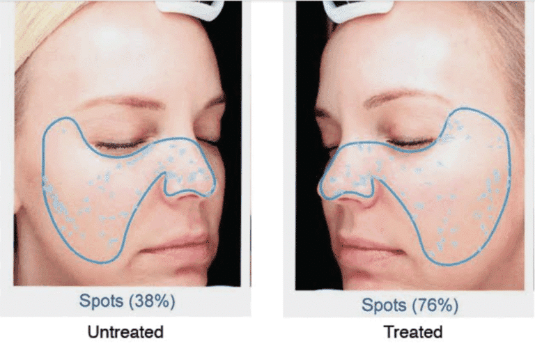 spot reduction treatment san diego