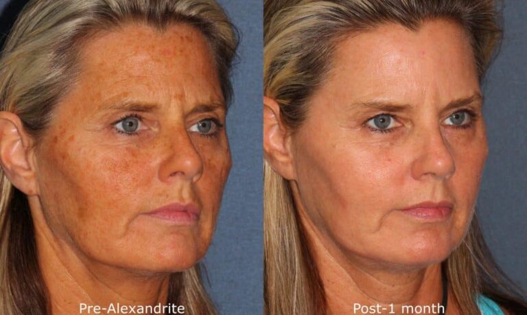 Before and after oblique image of Alexandrite laser treatment on a female's face performed by Dr. Groff at our San Diego medical spa