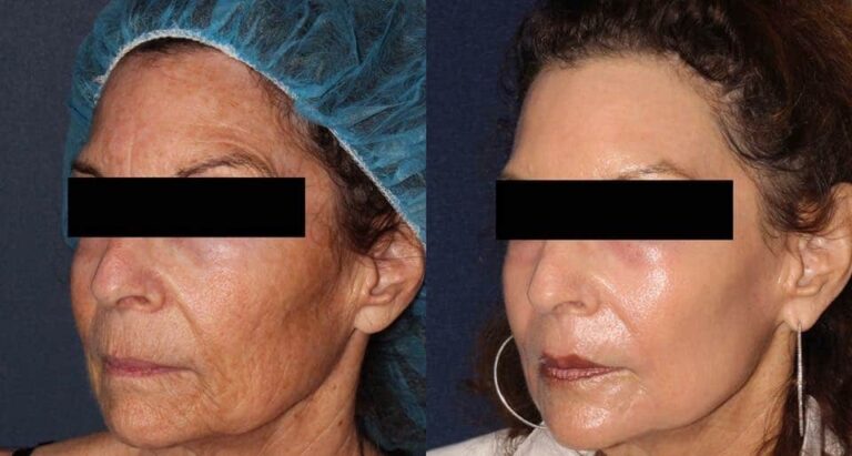 Before and after oblique image of laser resurfacing treatment on a female's face performed by Dr. Groff at our San Diego medical spa
