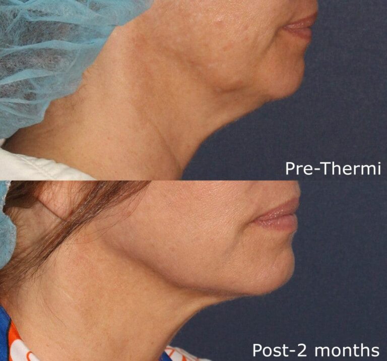 Before and after side image of ThermiTight treatment on a female's chin and neck performed by Dr. Groff at our San Diego medical clinic
