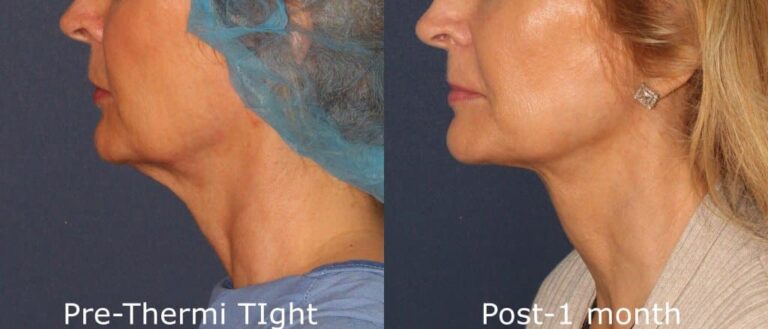 Before and after side image of ThermiTight treatment on a female's face performed by Dr. Groff at our San Diego medical spa