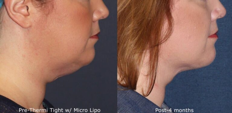 Before and after side image of micro-lipo and ThermiTight treatment on a female's jawline performed by Dr. Groff at our San Diego medical spa