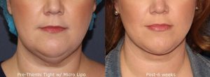 Before and after front image of micro-lipo and ThermiTight treatment on a female's jawline performed by Dr. Groff at our San Diego medical spa