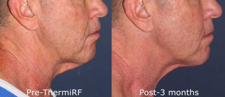 Before and after side image of ThermiRF treatment on a male's neck and jawline performed by Dr. Goldman at our San Diego medical spa