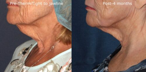 Before and after side image of ThermiTight treatment on a female's chin and neck performed by Dr. Groff at our San Diego medical spa