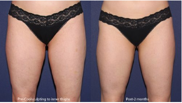 thigh fat reduction treatment results in San Diego, CA