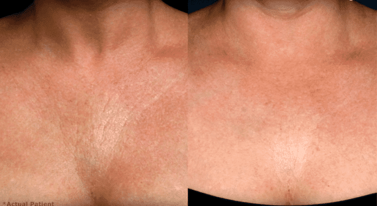 Before and after front image of Ulthera treatment on a female's chest performed by Dr. Fabi at our San Diego medical clinic