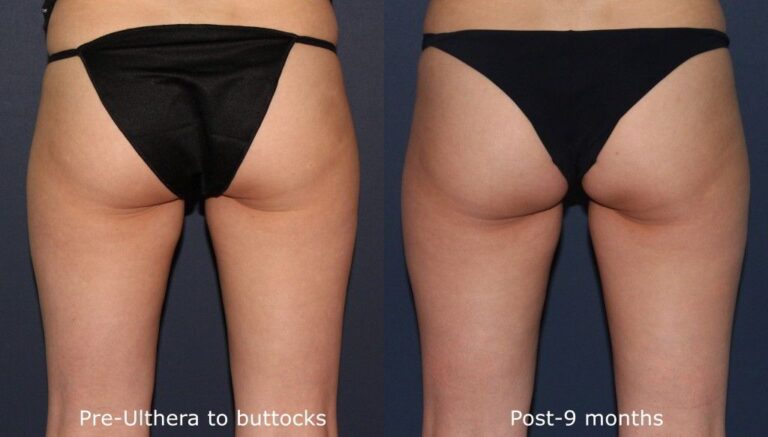Before and after back image of Ulthera treatment on a female's buttocks performed by Dr. Fabi at our San Diego medical clinic