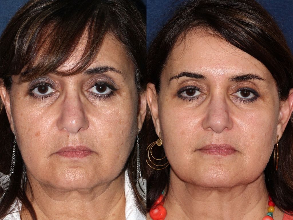 cosmetic laser dermatology Ultherapy Facial tightening treatment san diego ca