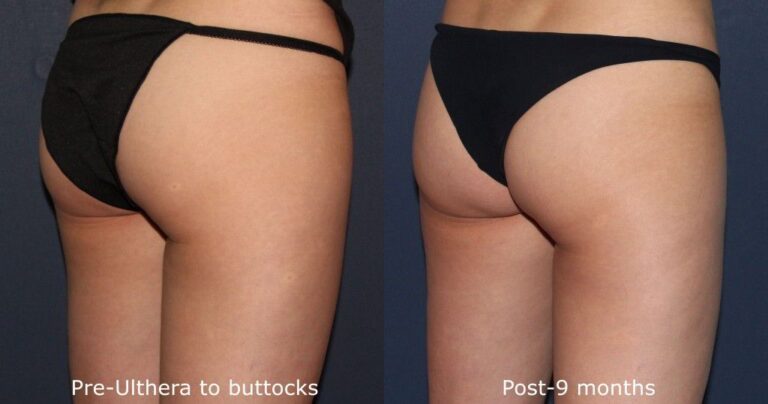 Before and after oblique image of Ultherapy treatment on a female's buttocks performed by Dr. Fabi at our San Diego medical spa