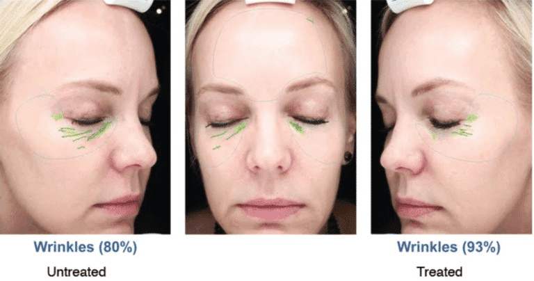 Before and after front and oblique image of microdermabrasion treatment on a female's face performed by Farzaneh Dr. Fabi at our San Diego medical spa