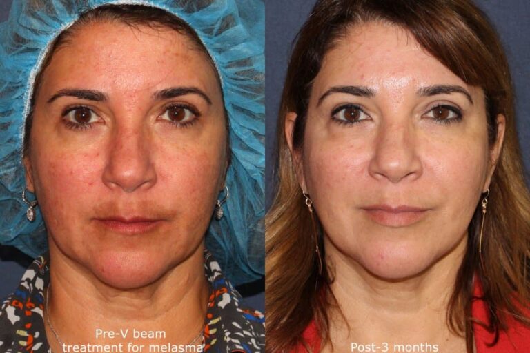 Before and after front image of Vbeam treatment on a female's facial redness performed by Dr. Fabi at our San Diego med spa