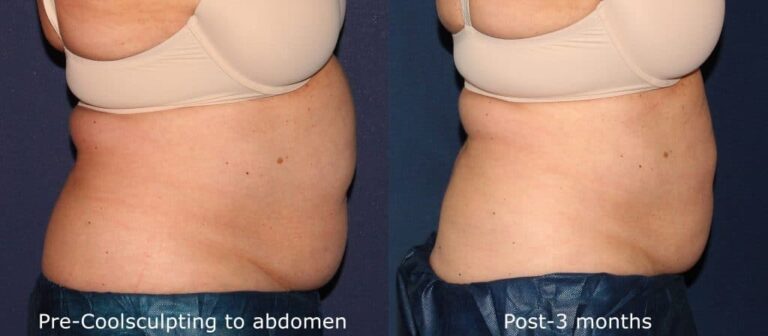 Before and after side image of CoolSculpting treatment on a female's abdomen performed by Dr. Wu at our San Diego med spa
