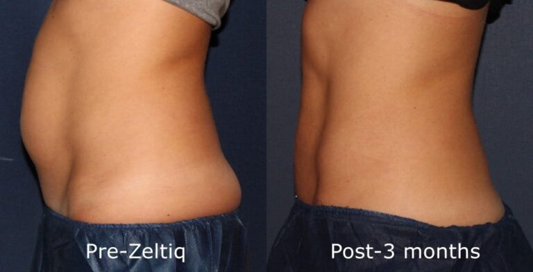 Before and after side image of CoolSculpting treatment on a female's abdomen performed by Dr. Groff at our San Diego medical clinic