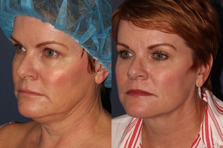 Before and after oblique image of ThermiTight treatment on a female's chin performed by Dr. Wu at our San Diego medical clinic