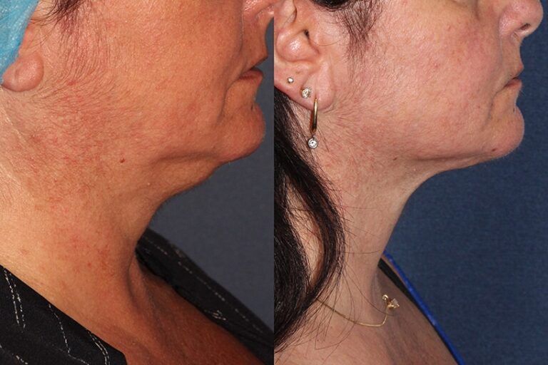 Before and after side image of ThermiTight treatment on a female's jawline performed by Dr. Wu at our San Diego medical spa